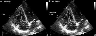 Pre-dive Whole-Body Vibration Better Reduces Decompression-Induced Vascular Gas Emboli than Oxygenation or a Combination of Both